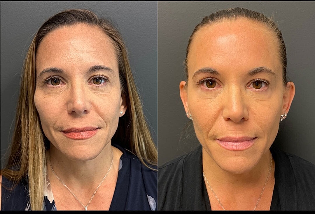 Biostimulators Before & After