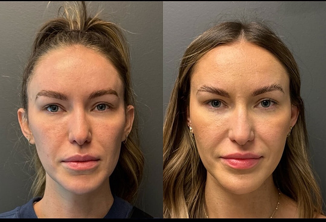 Biostimulators Before & After
