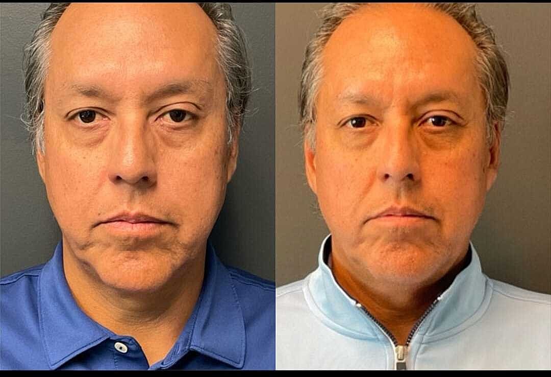 Biostimulators Before & After