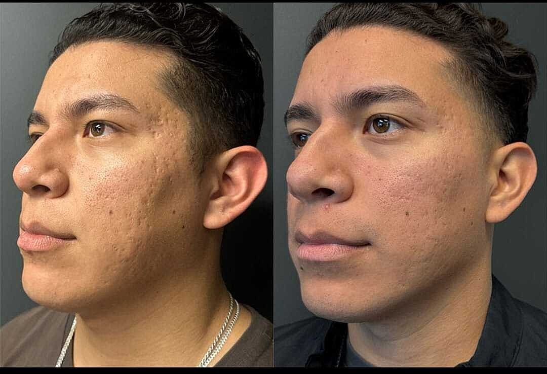 Biostimulators Before & After