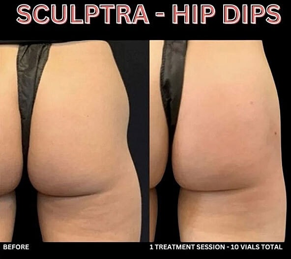 Biostimulators Before & After