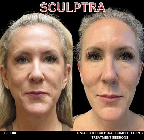 Biostimulators Before & After