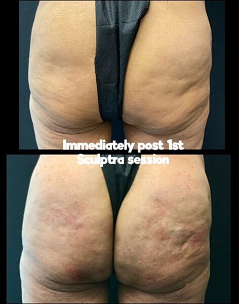 Biostimulators Before & After