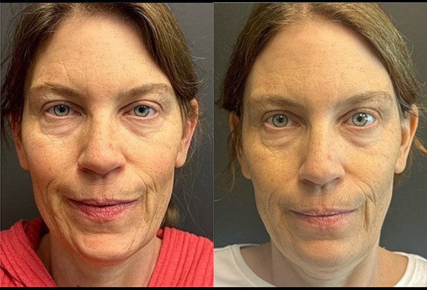 Biostimulators Before & After