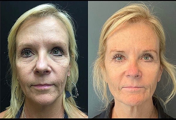 Biostimulators Before & After