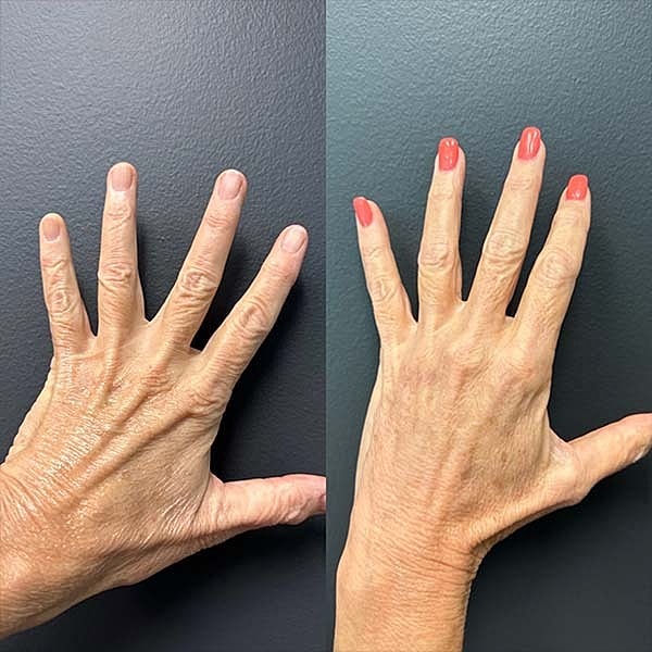 Biostimulators Before & After