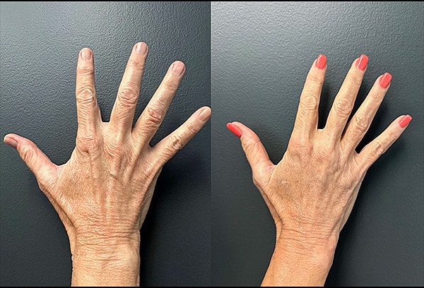 Biostimulators Before & After