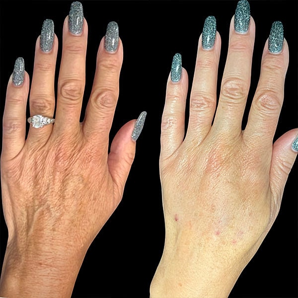 Biostimulators Before & After