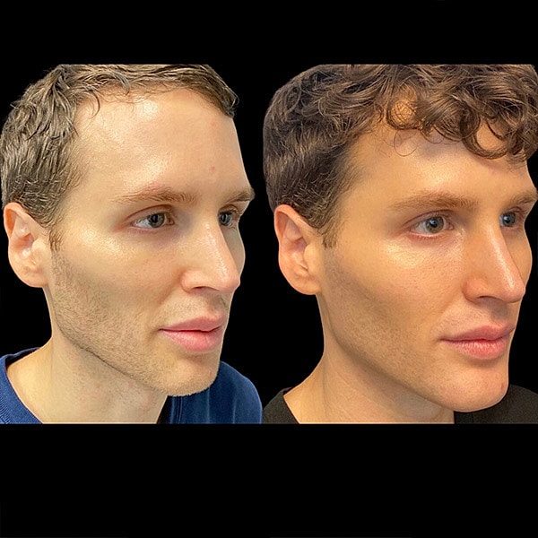 Biostimulators Before & After