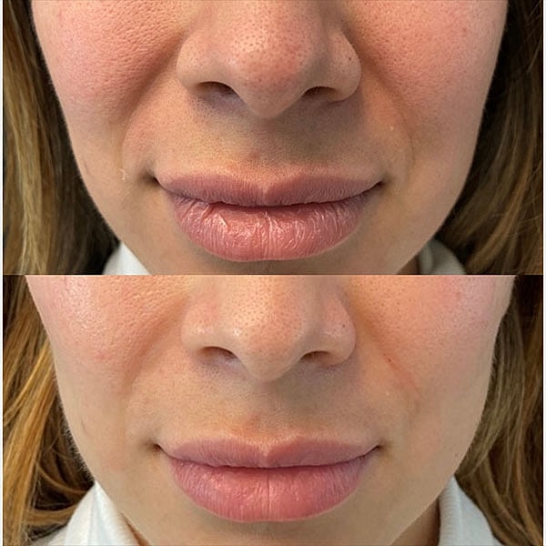 Biostimulators Before & After