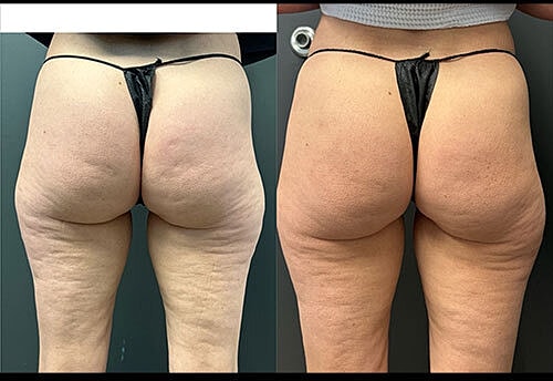 Biostimulators Before & After