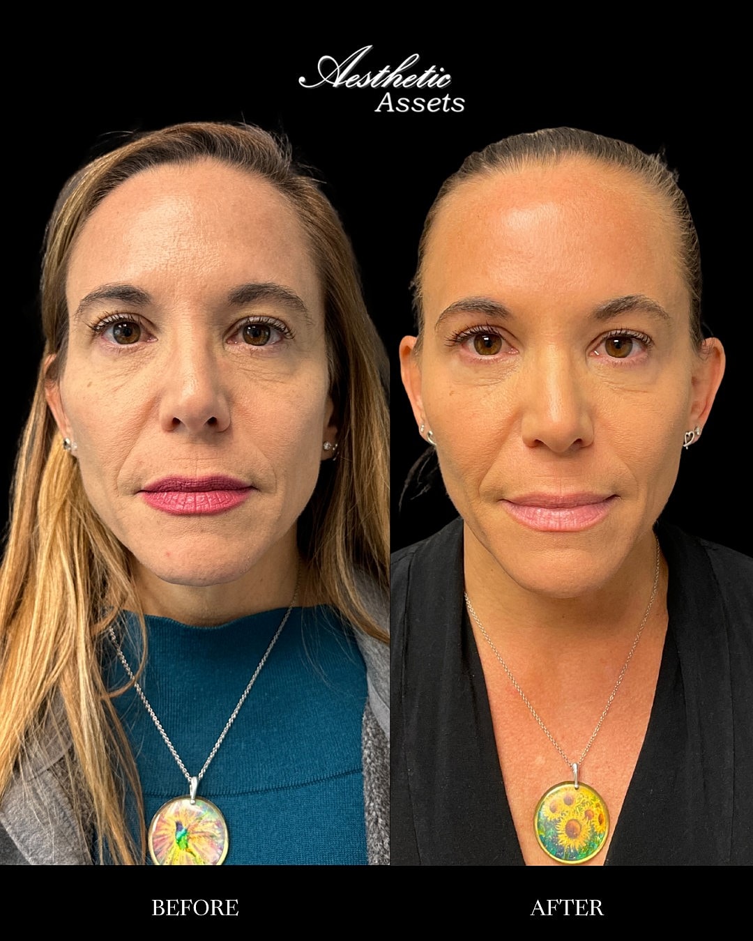 Biostimulators Before & After