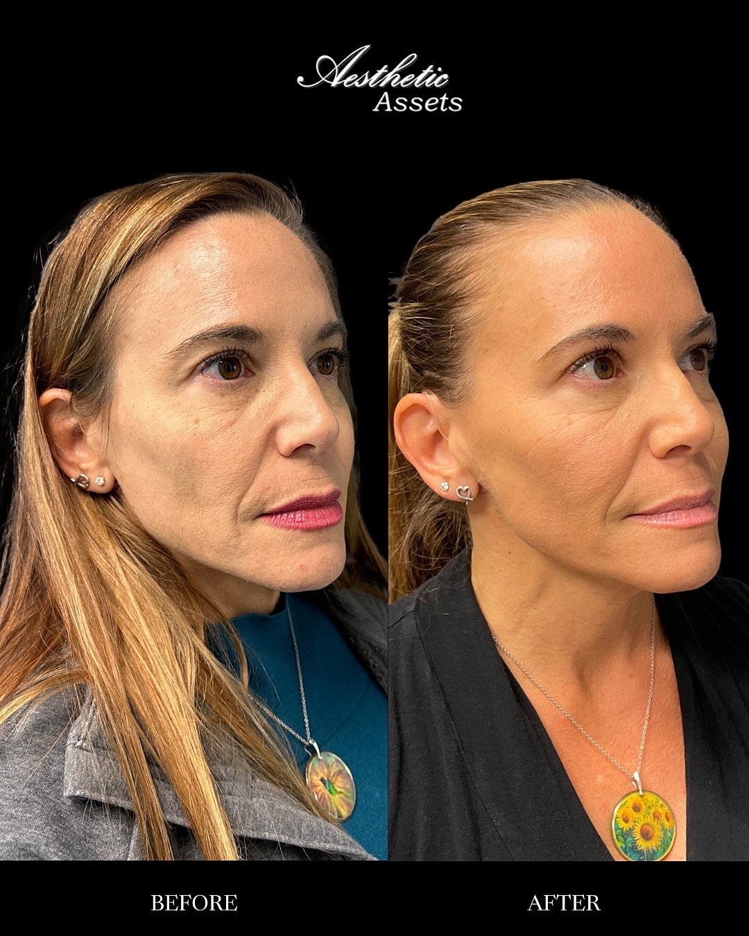 Biostimulators Before & After