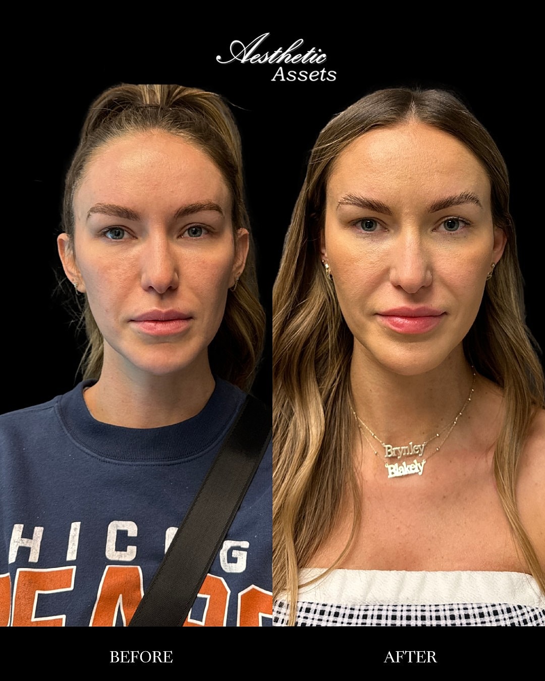 Biostimulators Before & After
