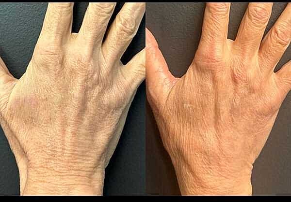 Hand Rejuvenation Before & After
