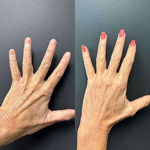 Hand Rejuvenation Before & After