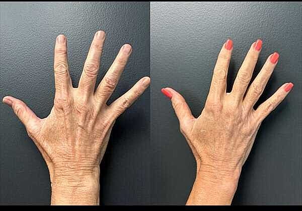 Hand Rejuvenation Before & After