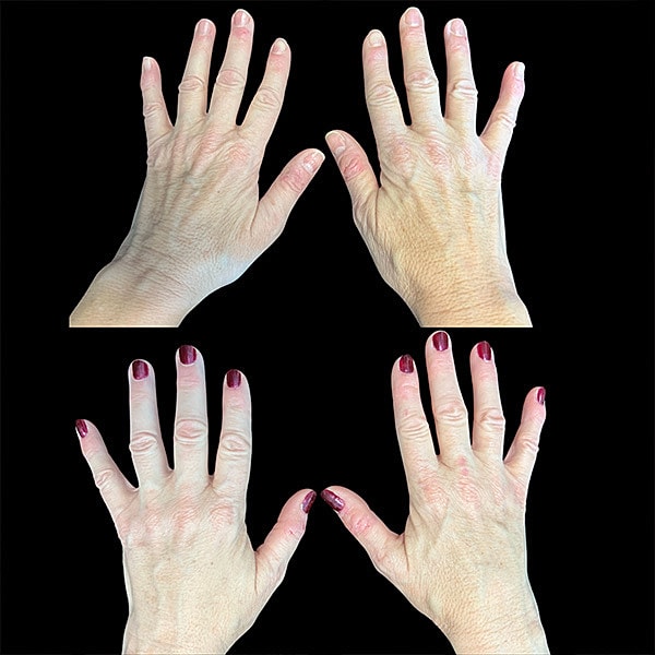 Hand Rejuvenation Before & After