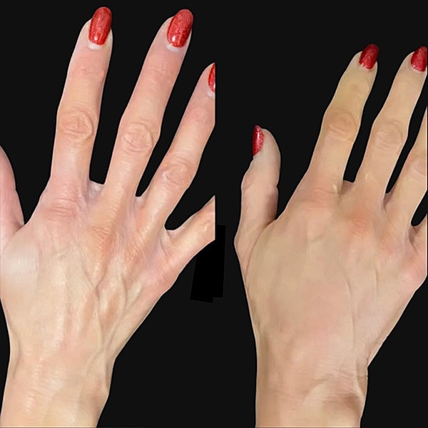 Hand Rejuvenation Before & After