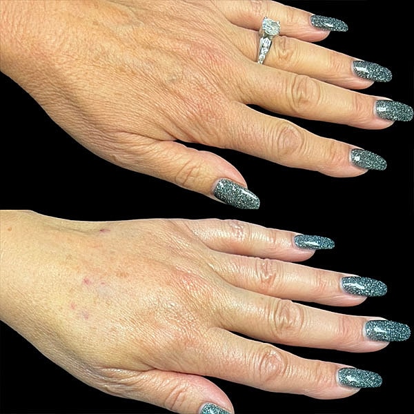 Hand Rejuvenation Before & After