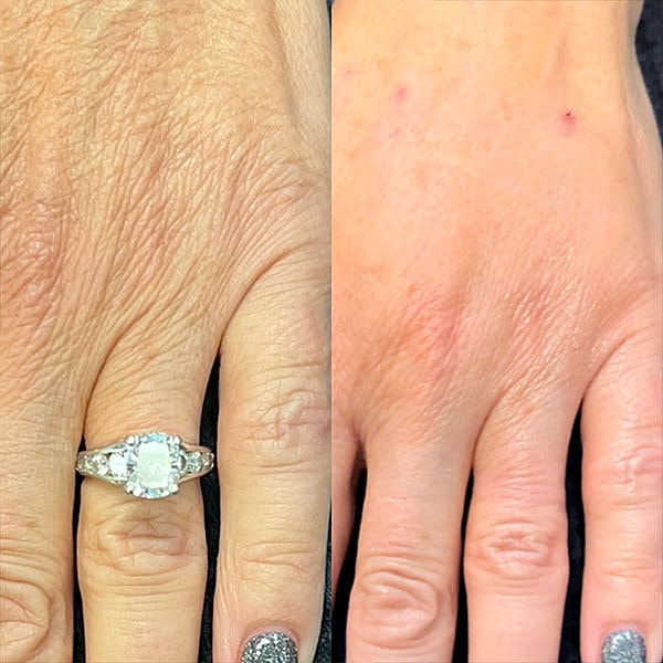 Hand Rejuvenation Before & After