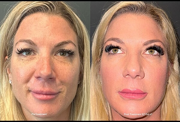 Prf Ez Gel Before & After