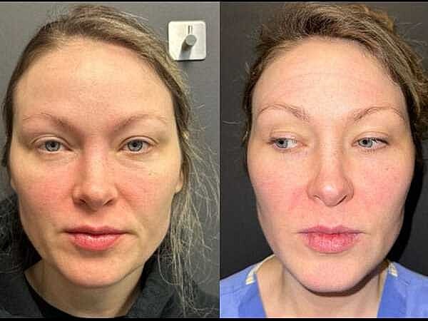 Prf Ez Gel Before & After