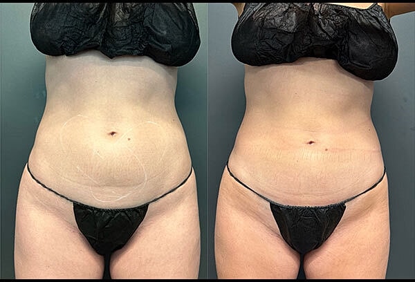 Body Contouring Before & After