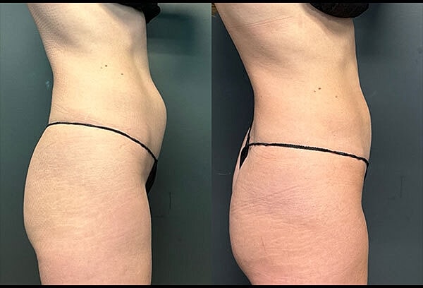 Body Contouring Before & After