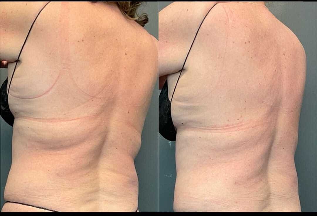Body Contouring Before & After