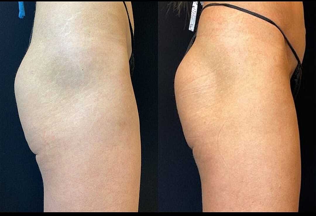 Body Contouring Before & After