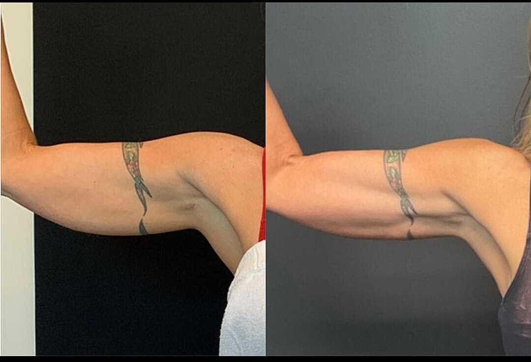 Body Contouring Before & After