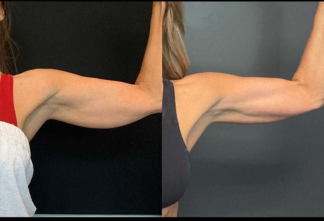Body Contouring Before & After