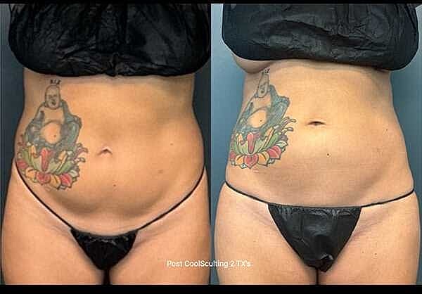 Body Contouring Before & After