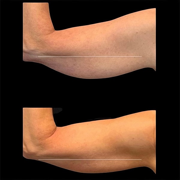 Body Contouring Before & After