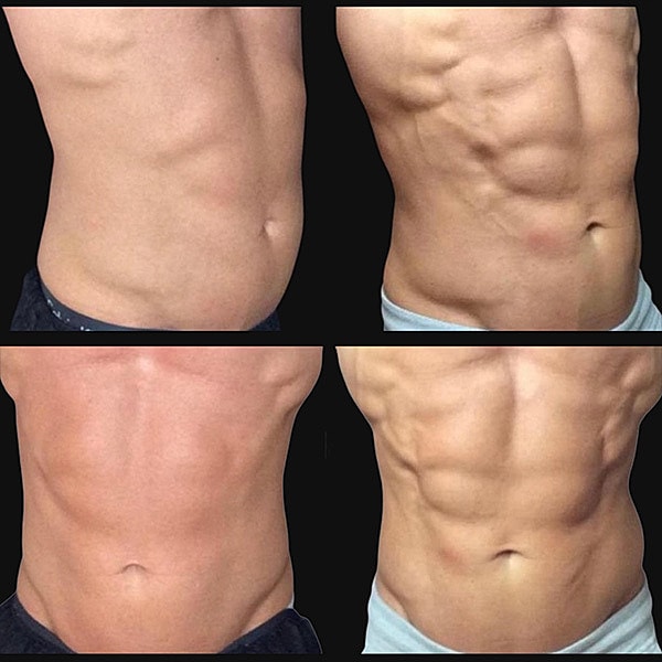 Body Contouring Before & After