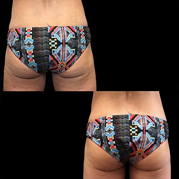 Body Contouring Before & After