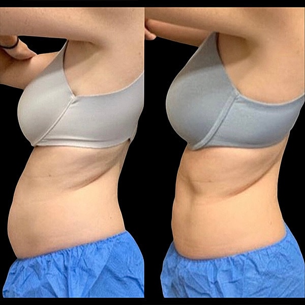 Body Contouring Before & After