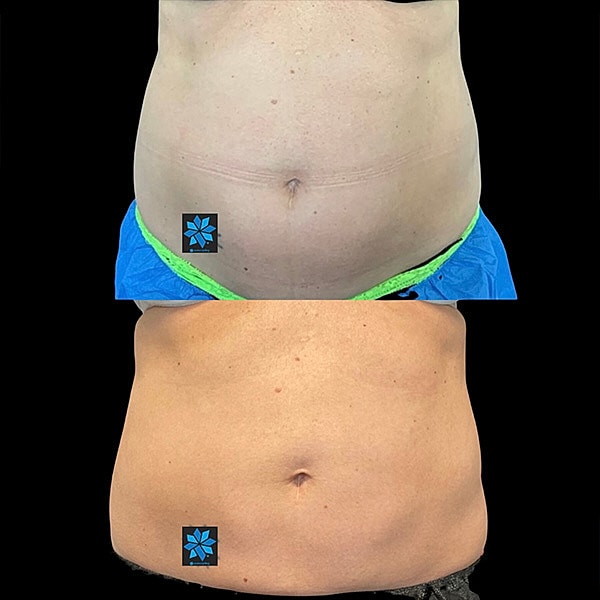 Body Contouring Before & After