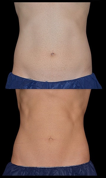 Body Contouring Before & After