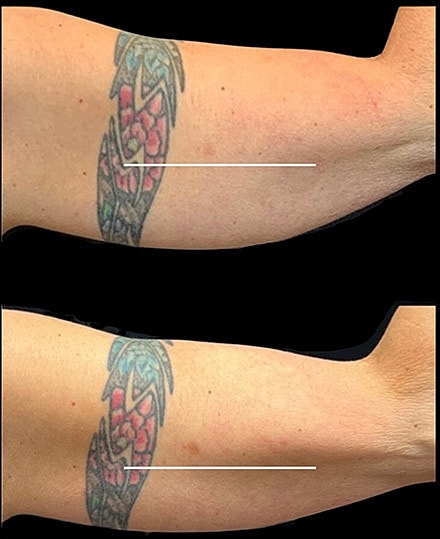 Body Contouring Before & After