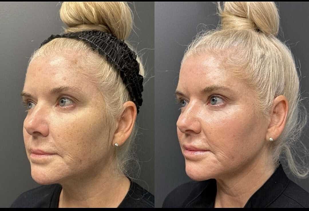 Chemical Peels Before & After