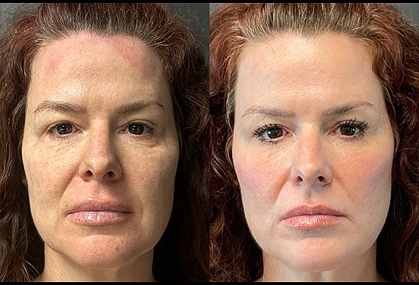 Chemical Peels Before & After