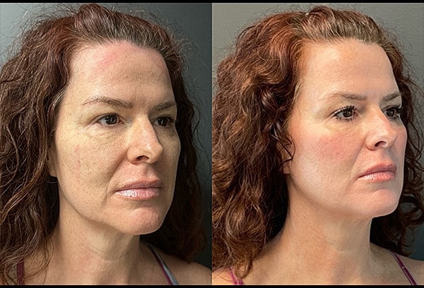 Chemical Peels Before & After