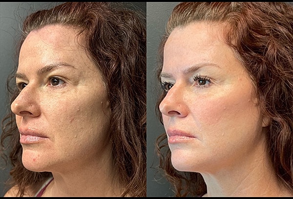 Chemical Peels Before & After