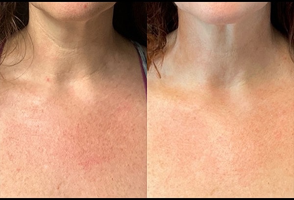 Chemical Peels Before & After