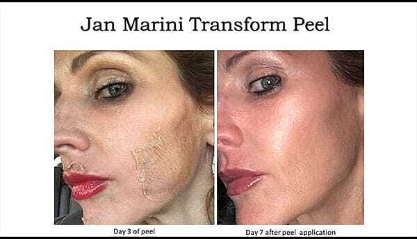 Chemical Peels Before & After