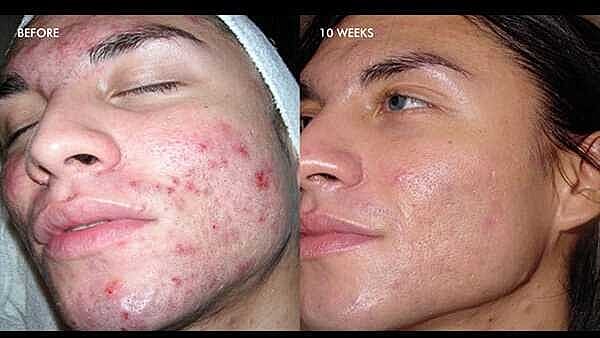 Chemical Peels Before & After