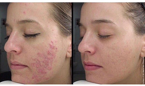 Chemical Peels Before & After