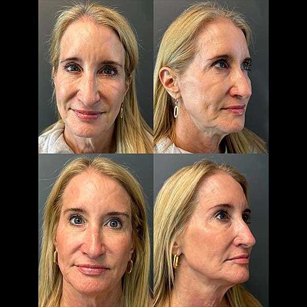 Juvederm Before & After